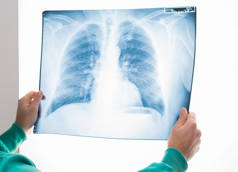 LUNG CANCER: COVID’S HIDDEN VICTIM – ISLANDERS URGED TO SEE THEIR GP