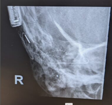 Cochlear Implant