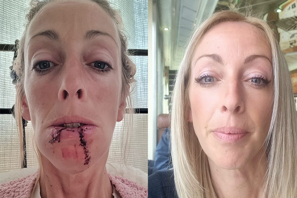 CARE WORKER SPEAKS OUT AFTER DOG ATTACK LEAVES HER PHYSICALLY AND EMOTIONALLY SCARRED