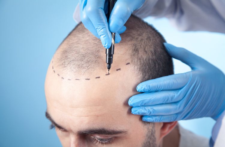 HAIR TRANSPLANT IS NO LONGER ABOUT LOOKING YOUNGER; IT’S ABOUT LOOKING IN CONTROL